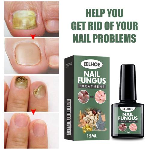 Salicyl Allantoin Nagellösung