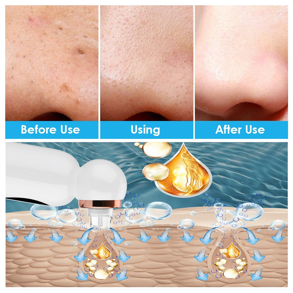 kaufsy | Hydrodermabrasion Mitesserentferner